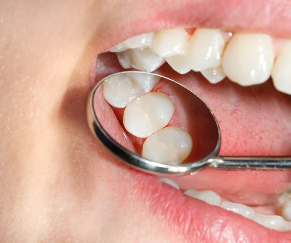 Teeth during treatment close-up in a dental clinic. Dental photo Teeth during treatment close-up in a dental clinic. Dental photopolymer composite filler.